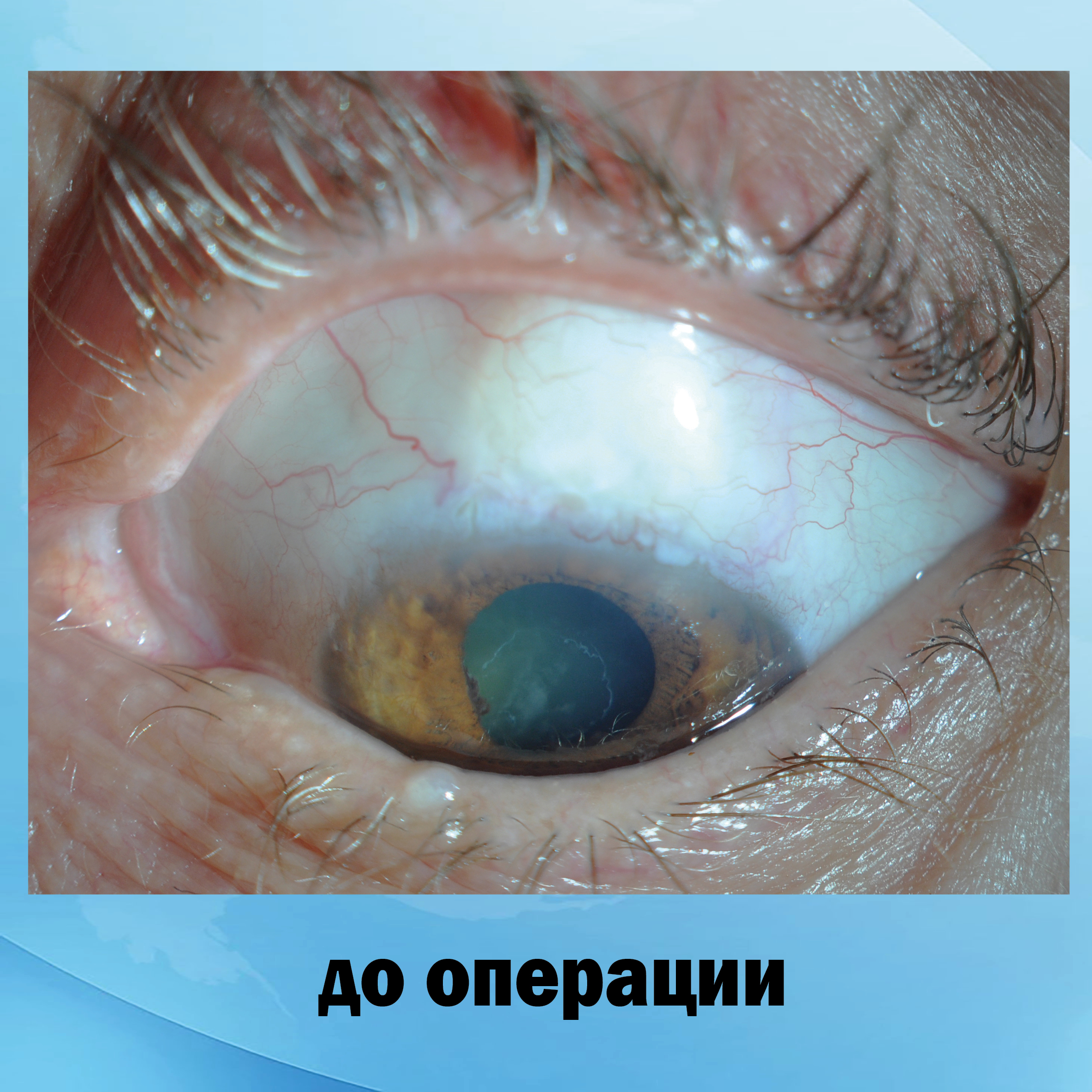 Оперированная глаукома левого глаза
